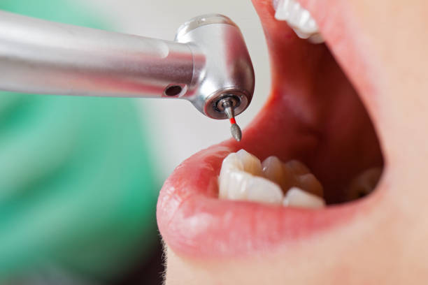 Best Emergency Root Canal Treatment in Josephine, TX